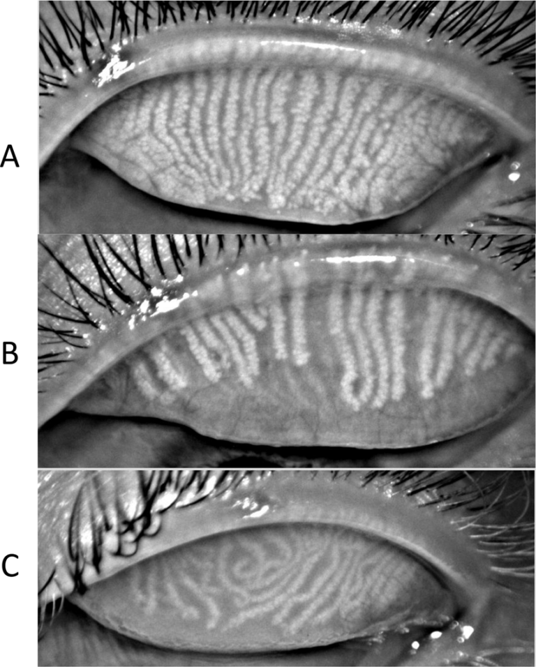 meibomian-gland-characteristics-a-typical-meibomian-gland-orientation